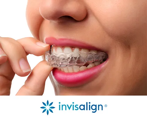 Invisalign - Virtually Invisible Braces