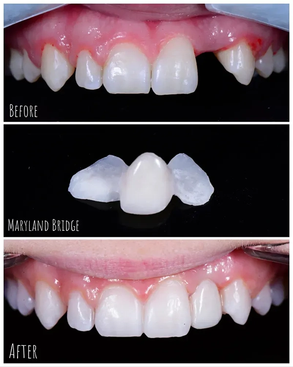 Dental Bridges