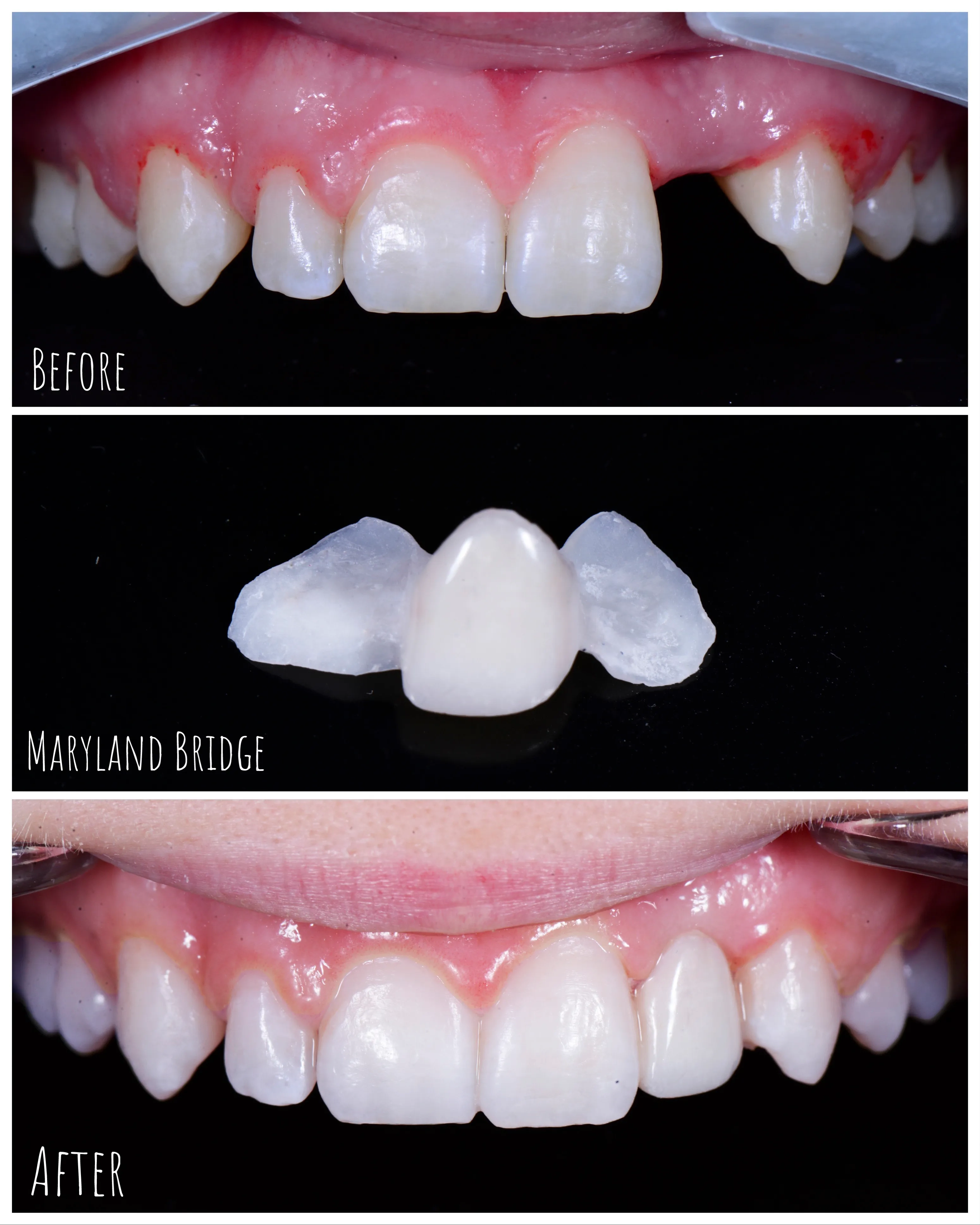 Teeth Whitening