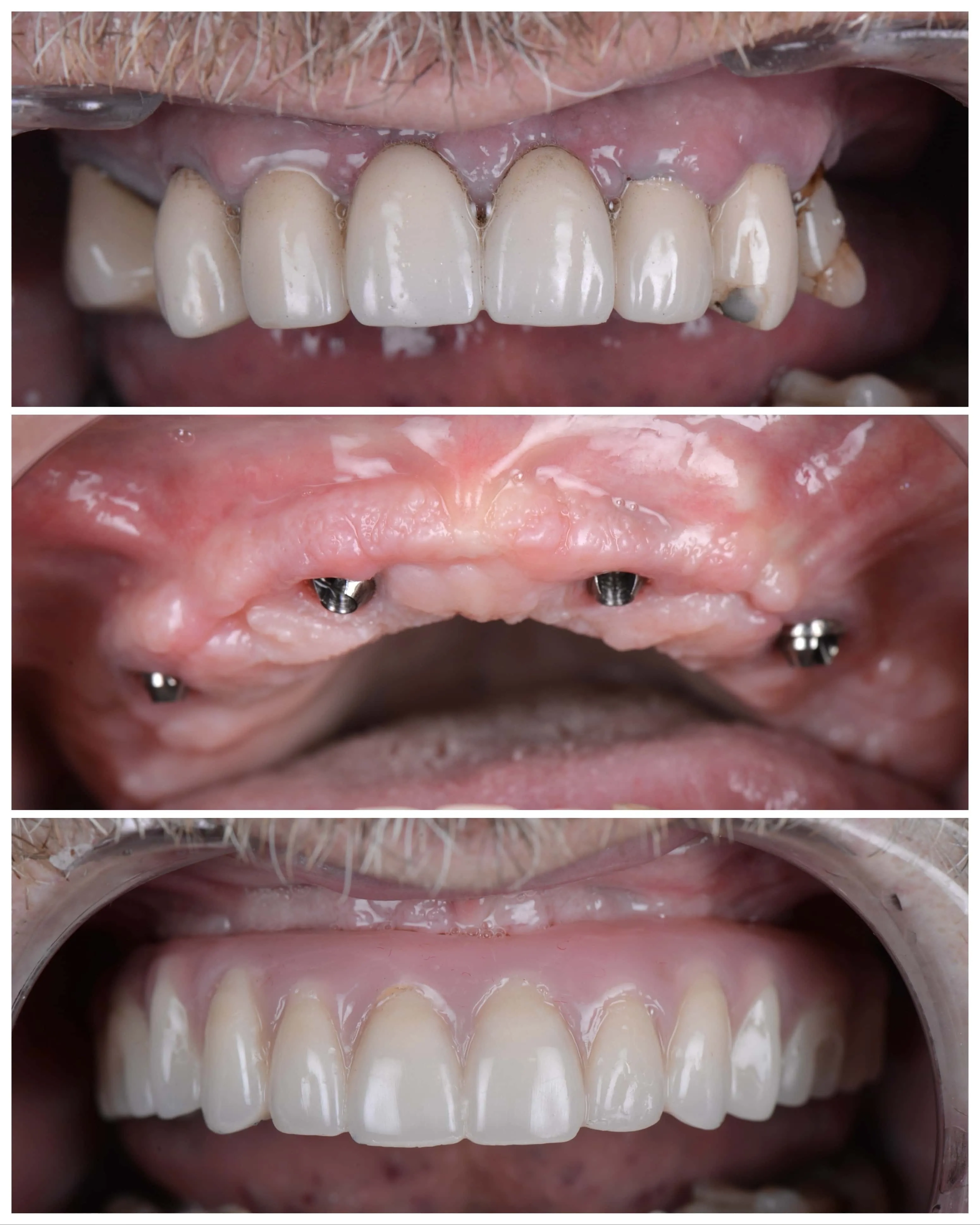 All-On-X Restoration