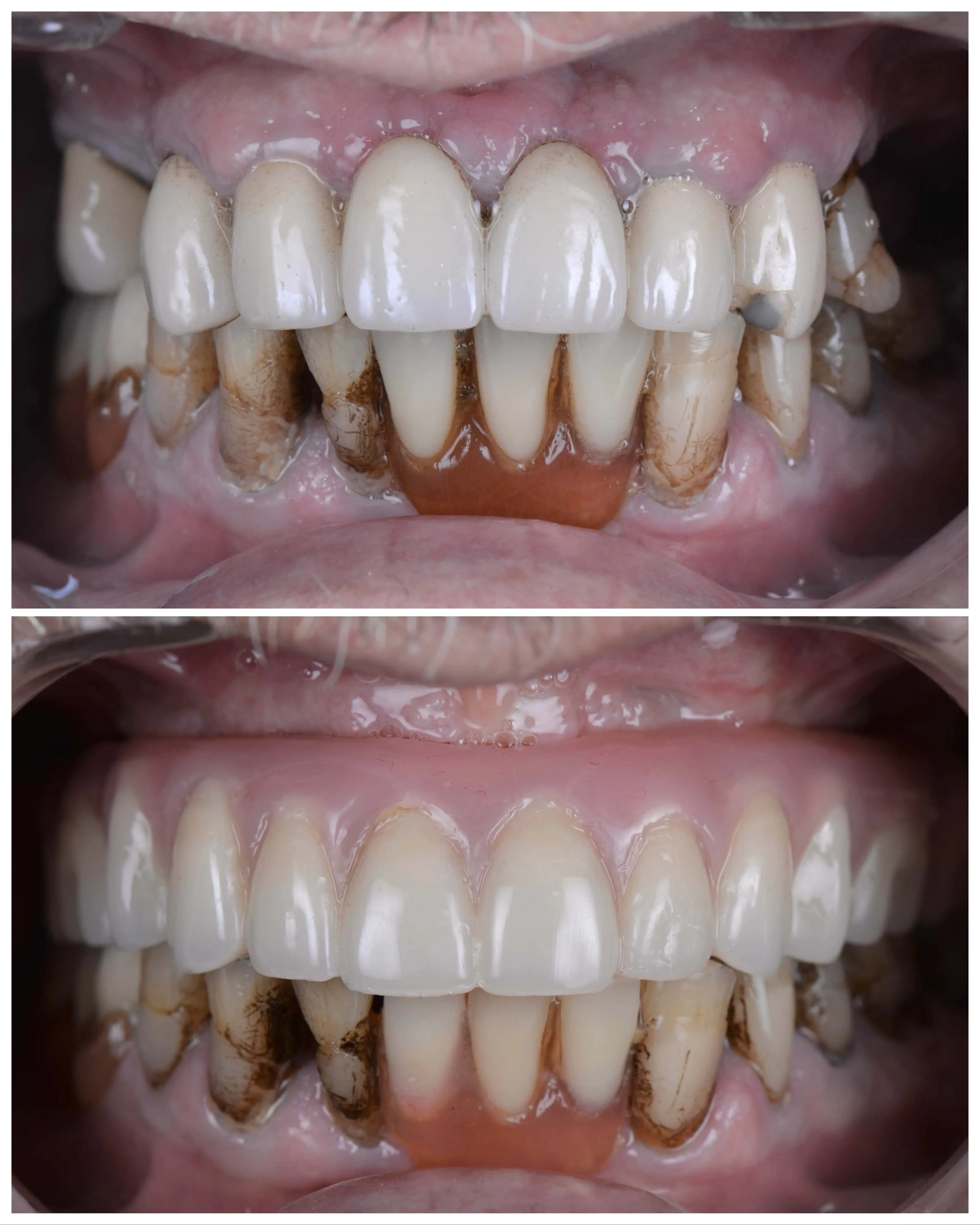 All-On-X Restoration