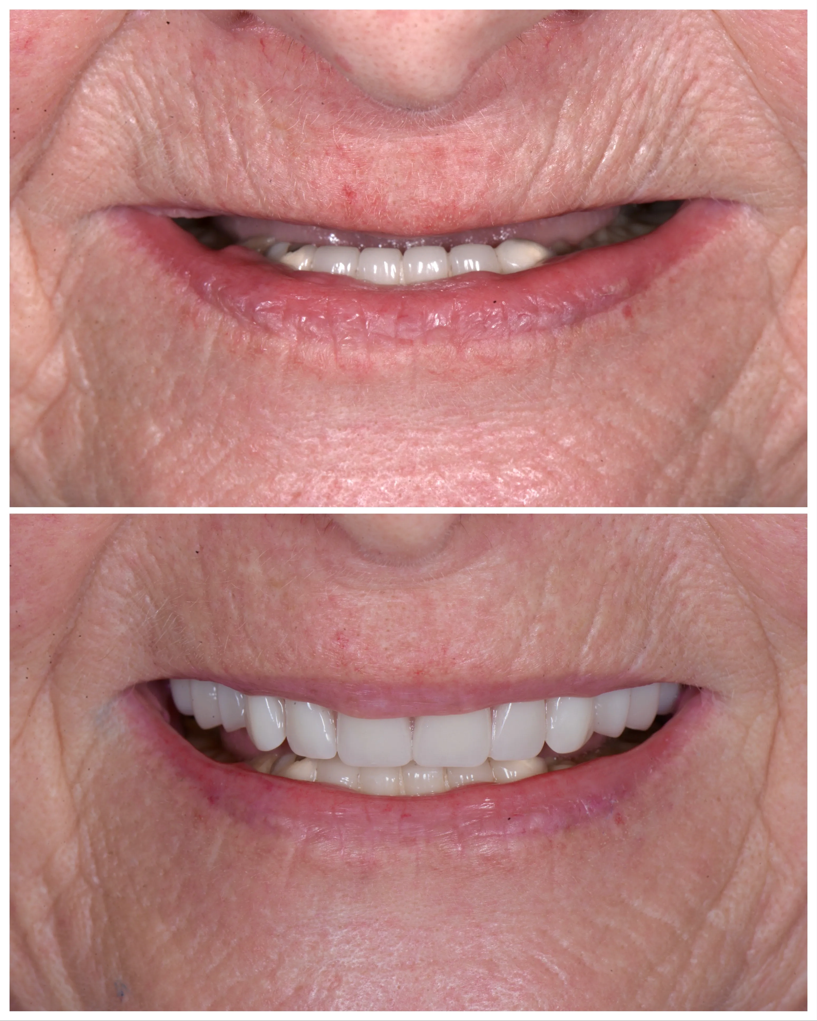 All-On-X Restoration