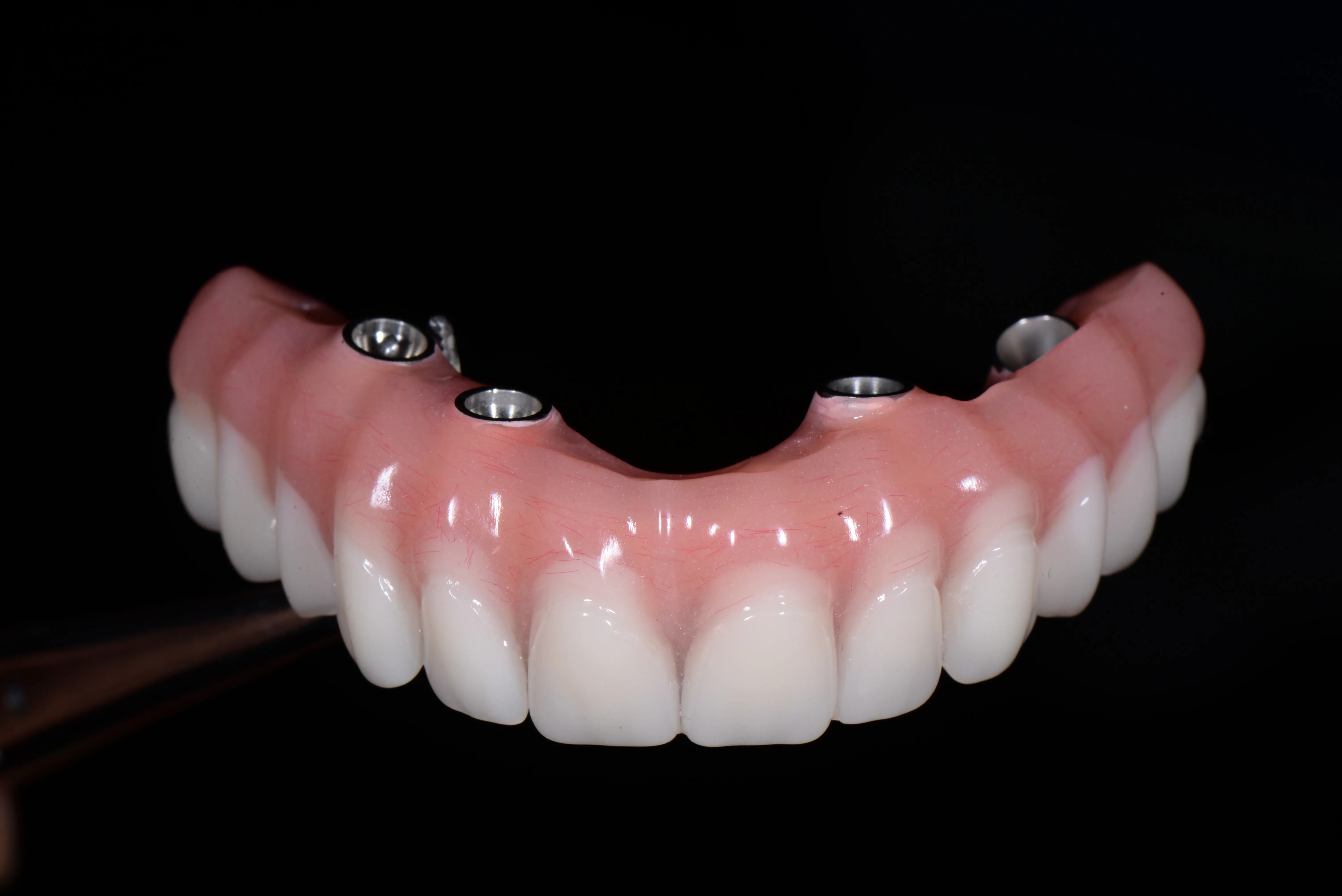 Implant Restorations