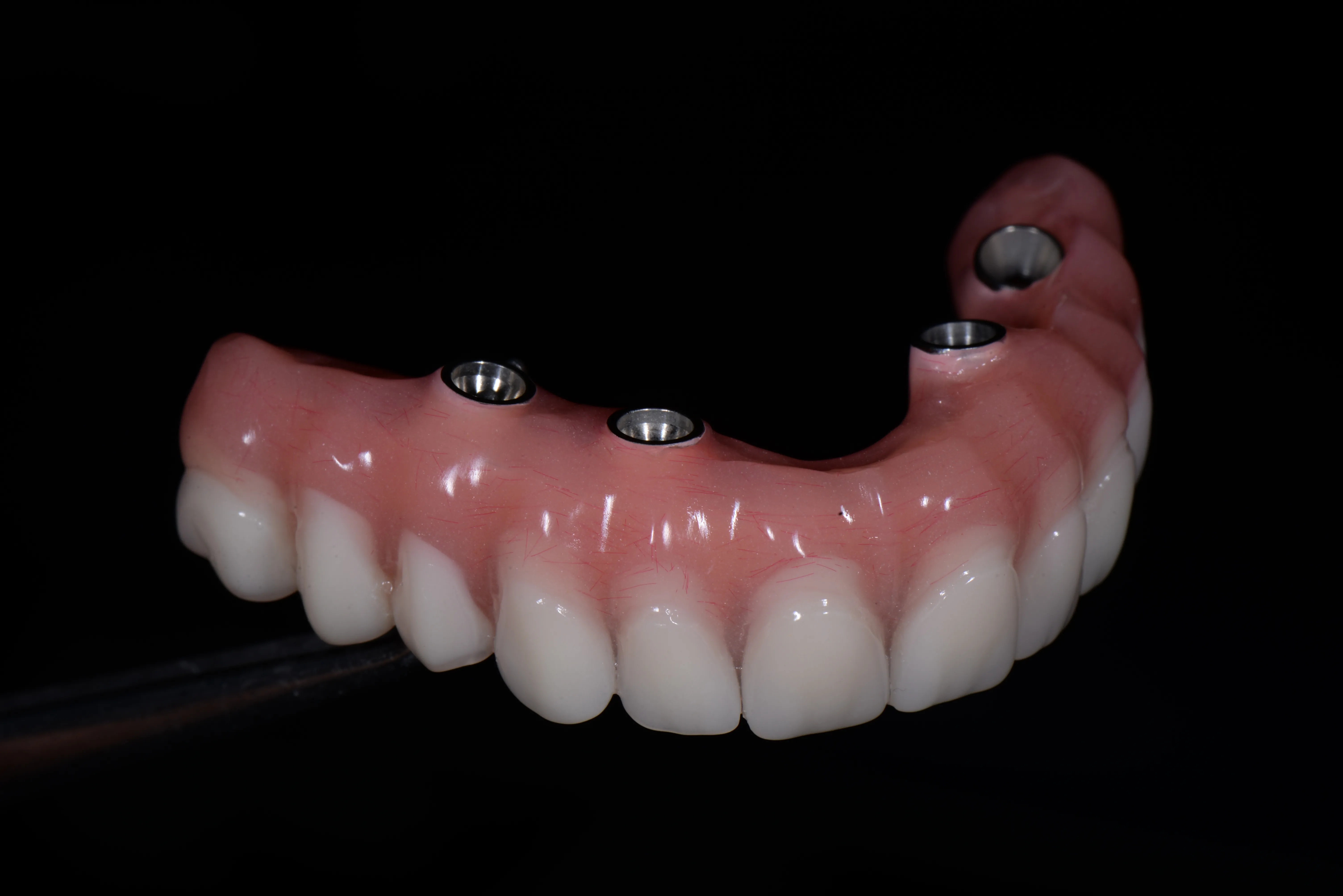 Implant Restorations