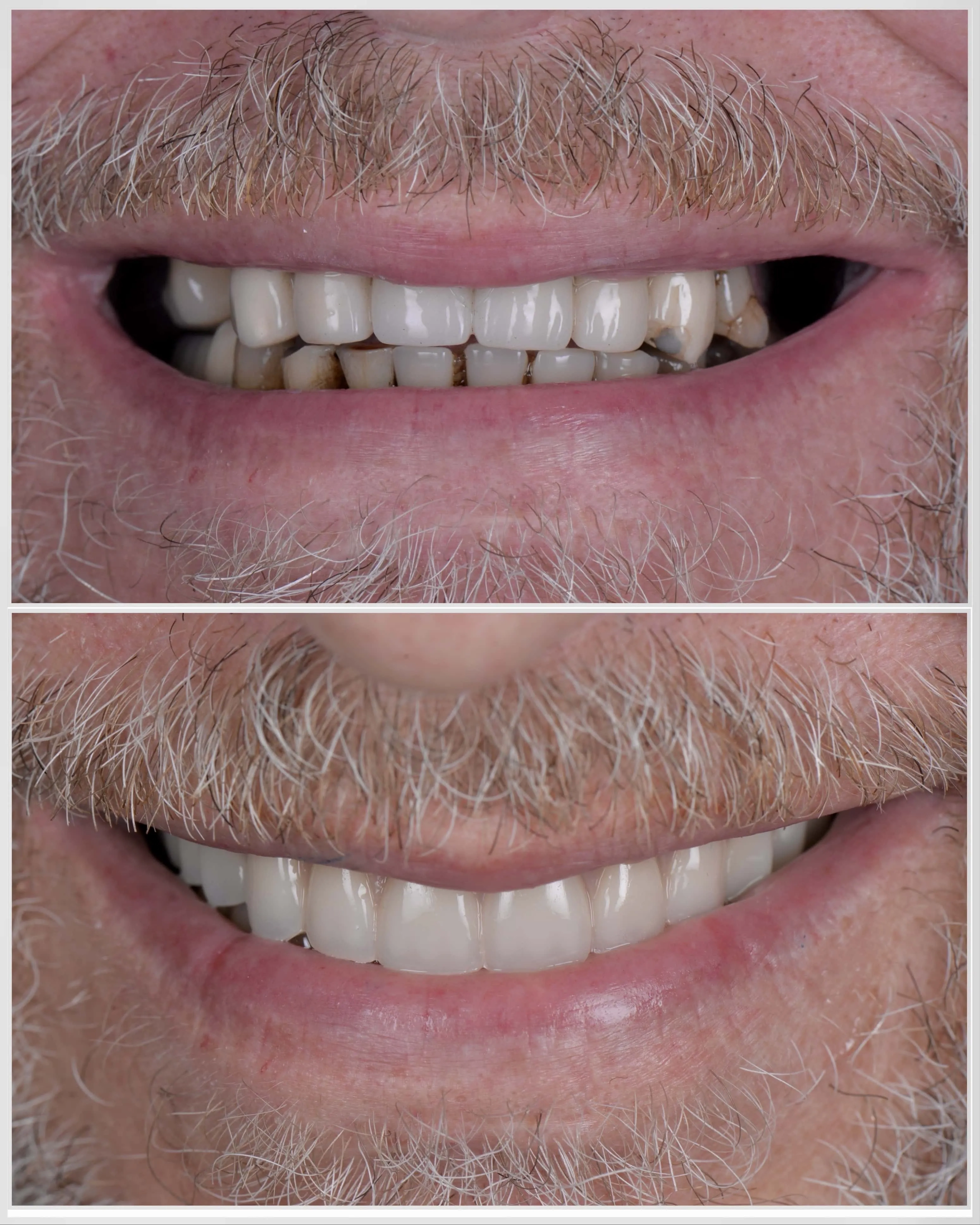 Implant Restorations