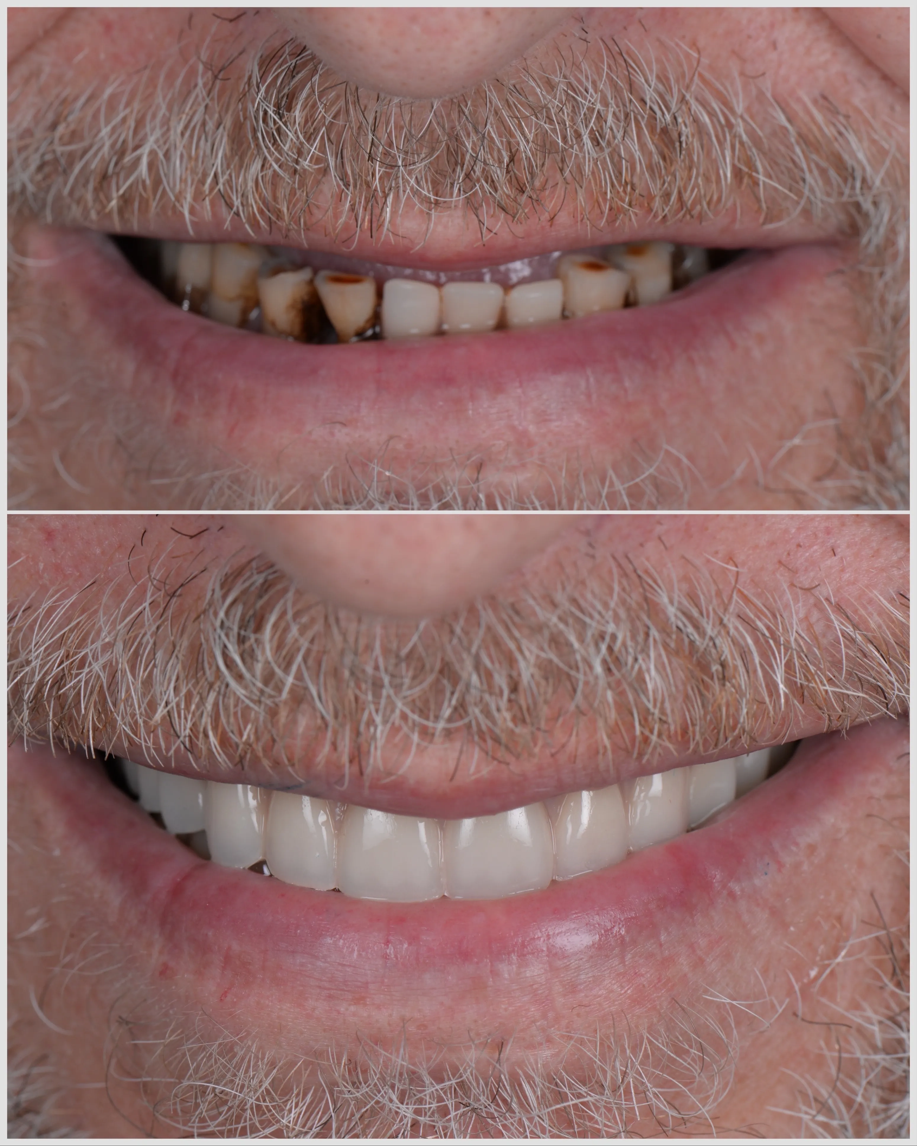 Implant Restorations