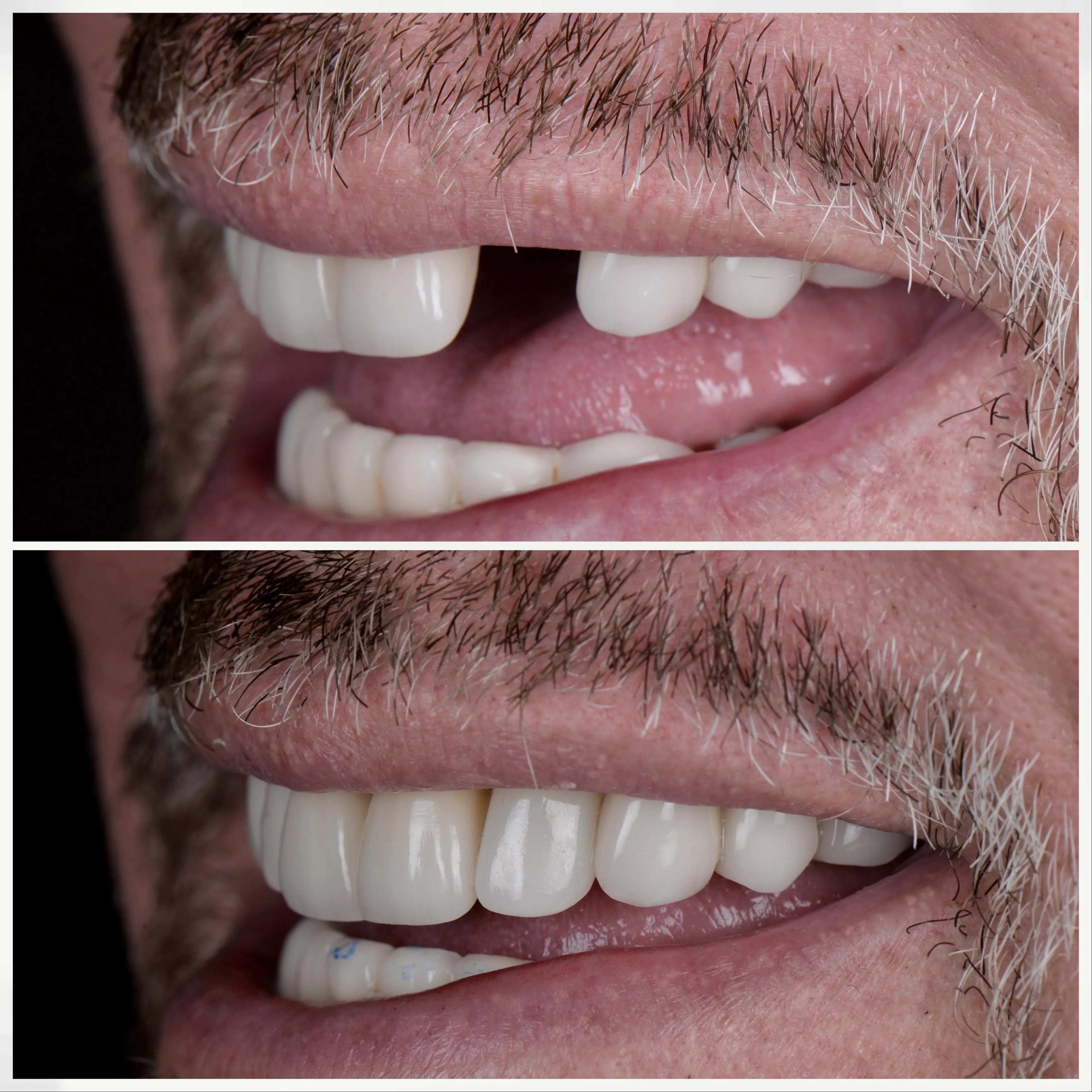 Implant Restorations