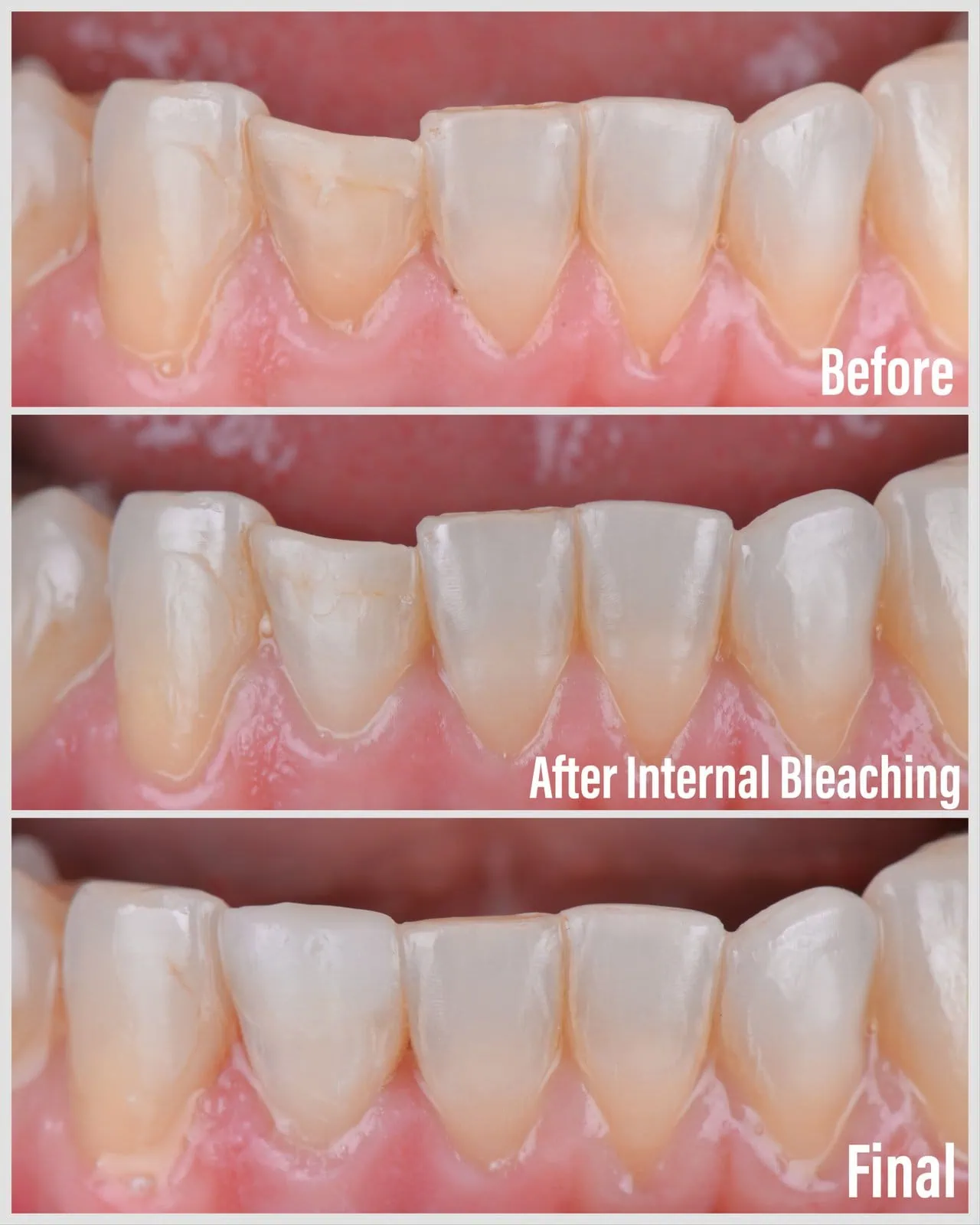 Teeth Whitening
