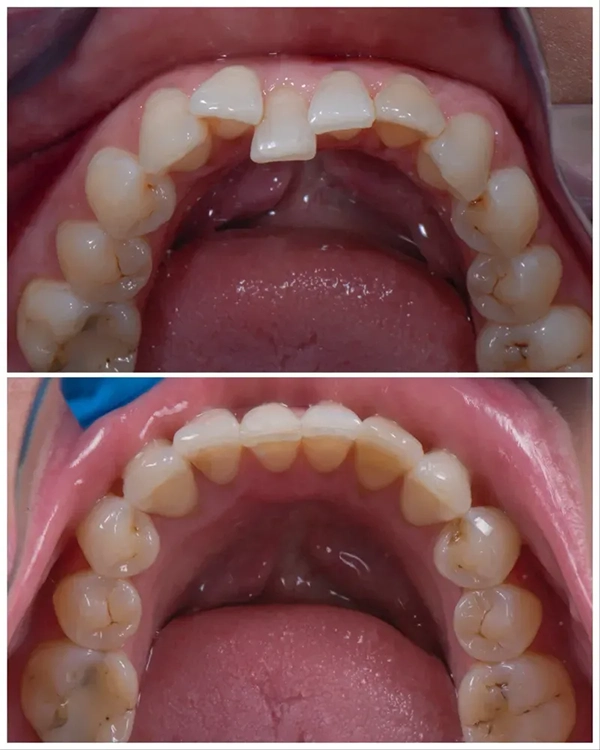 Invisalign