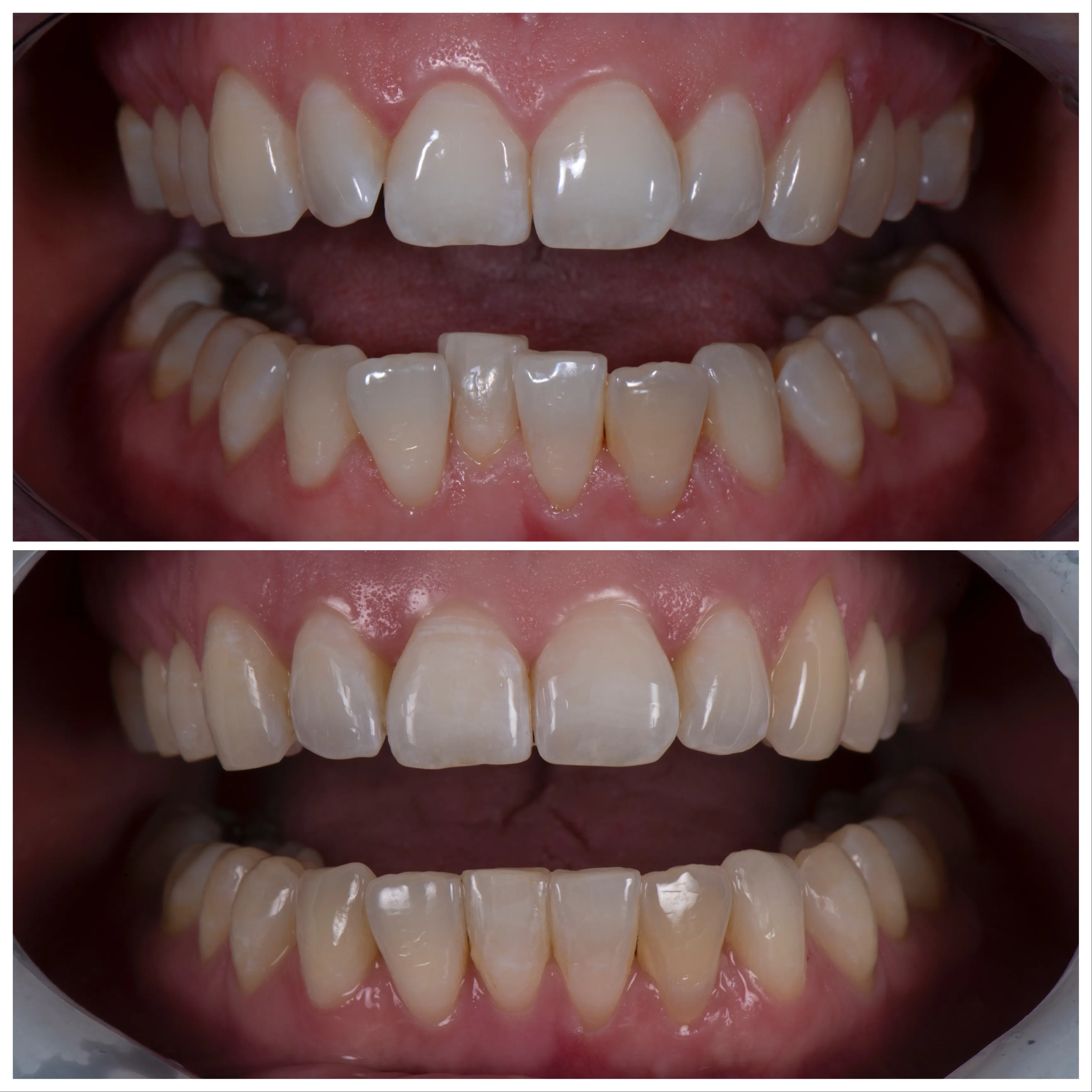 Invisalign