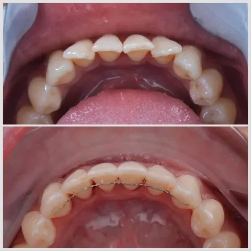 Invisalign