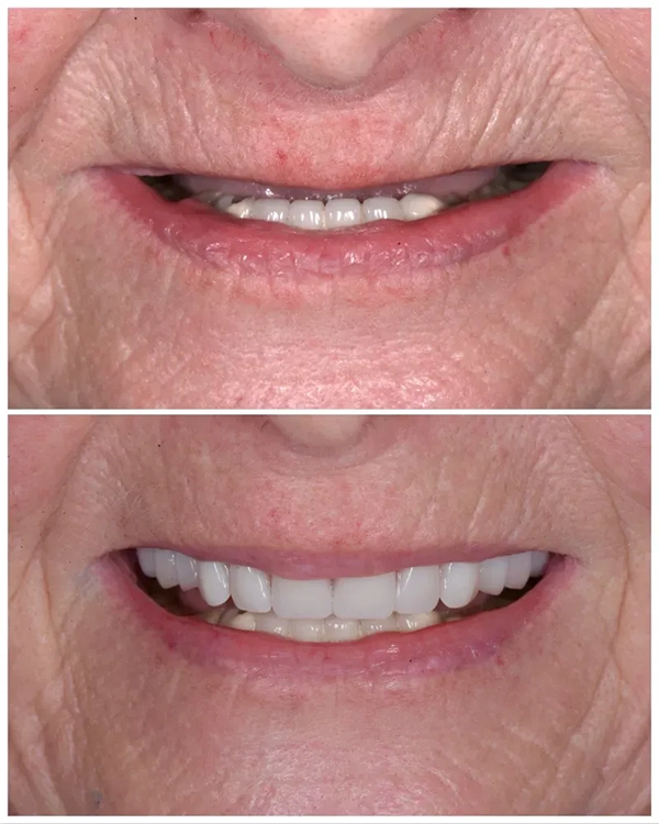 Implant Restorations