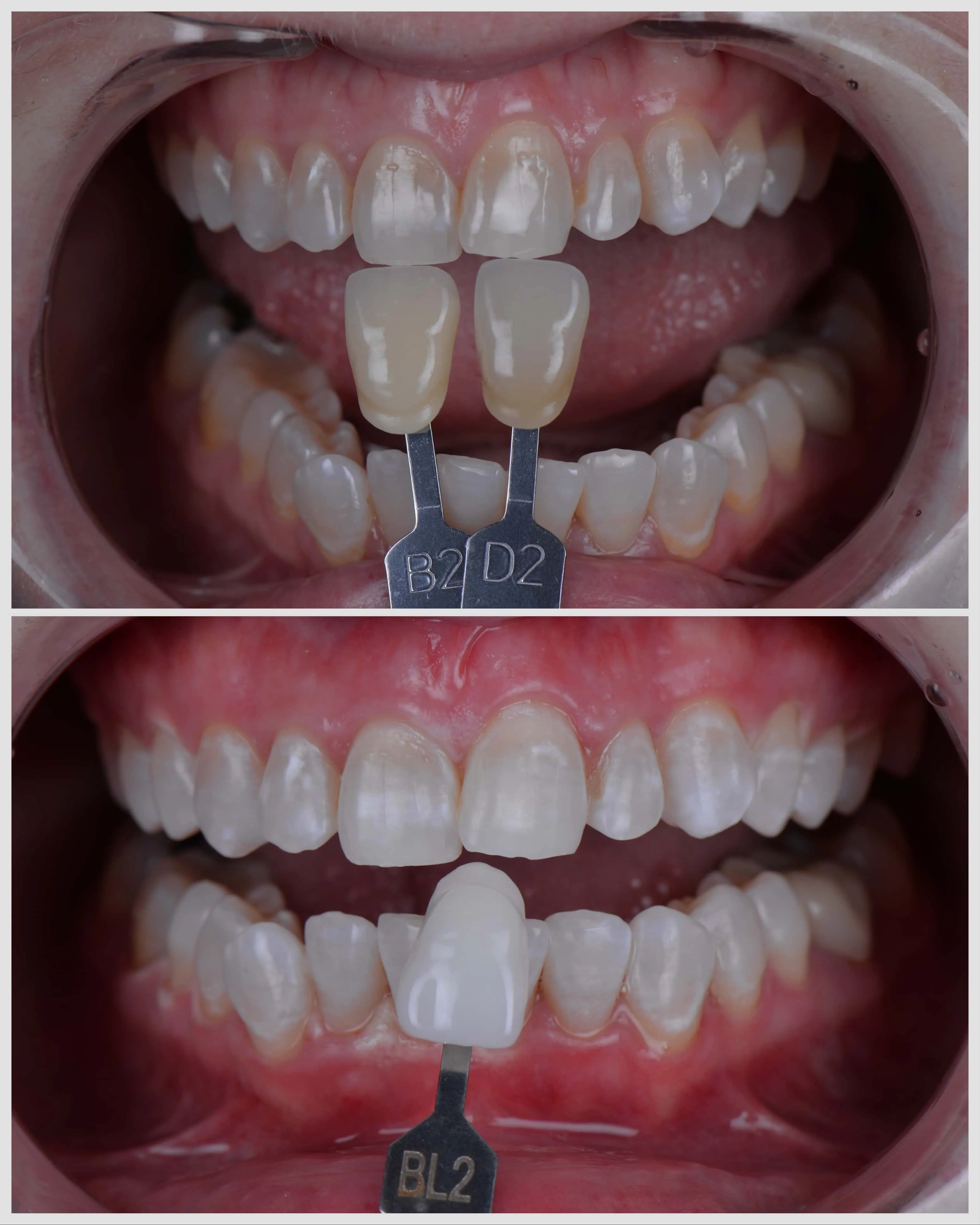 Teeth Whitening
