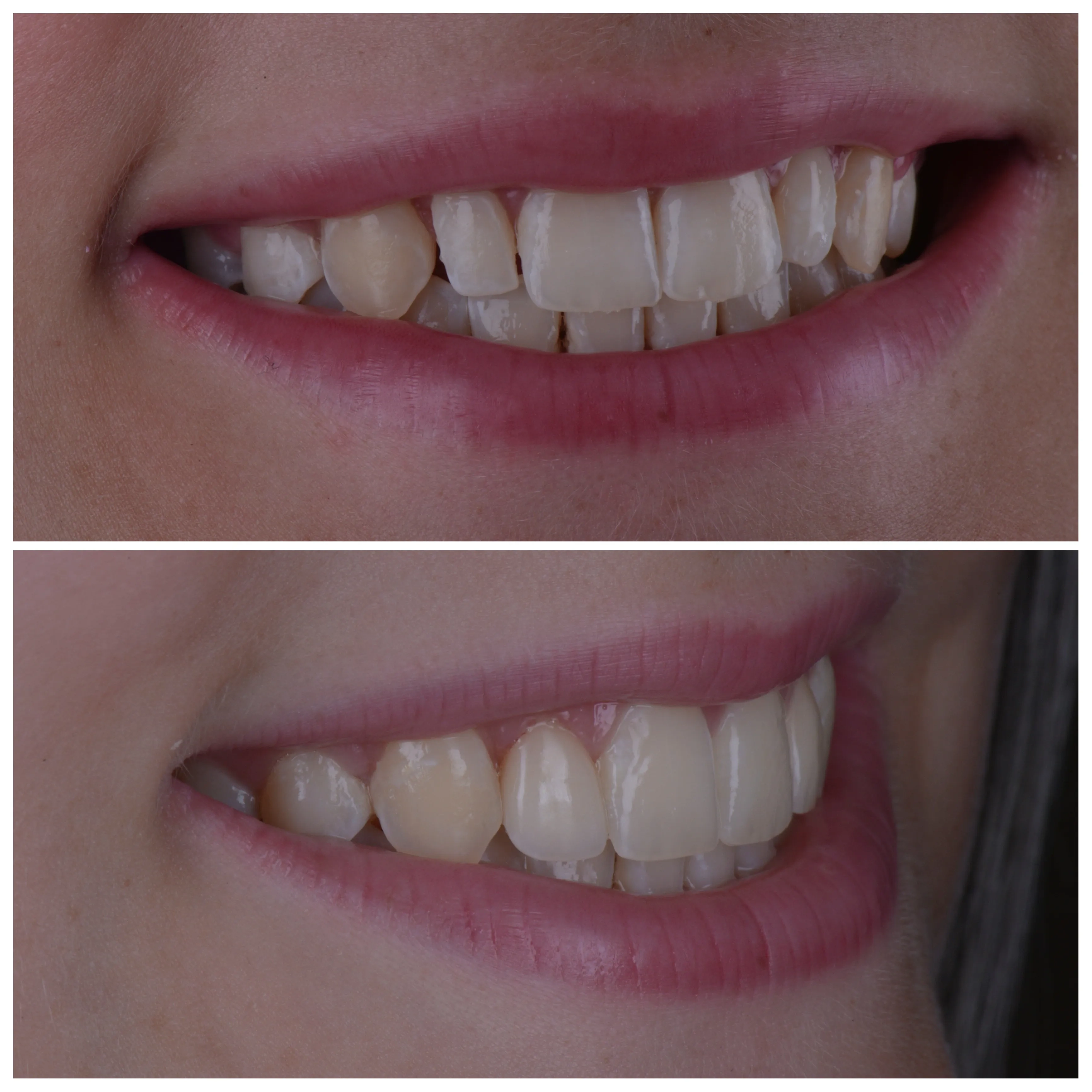 Veneers