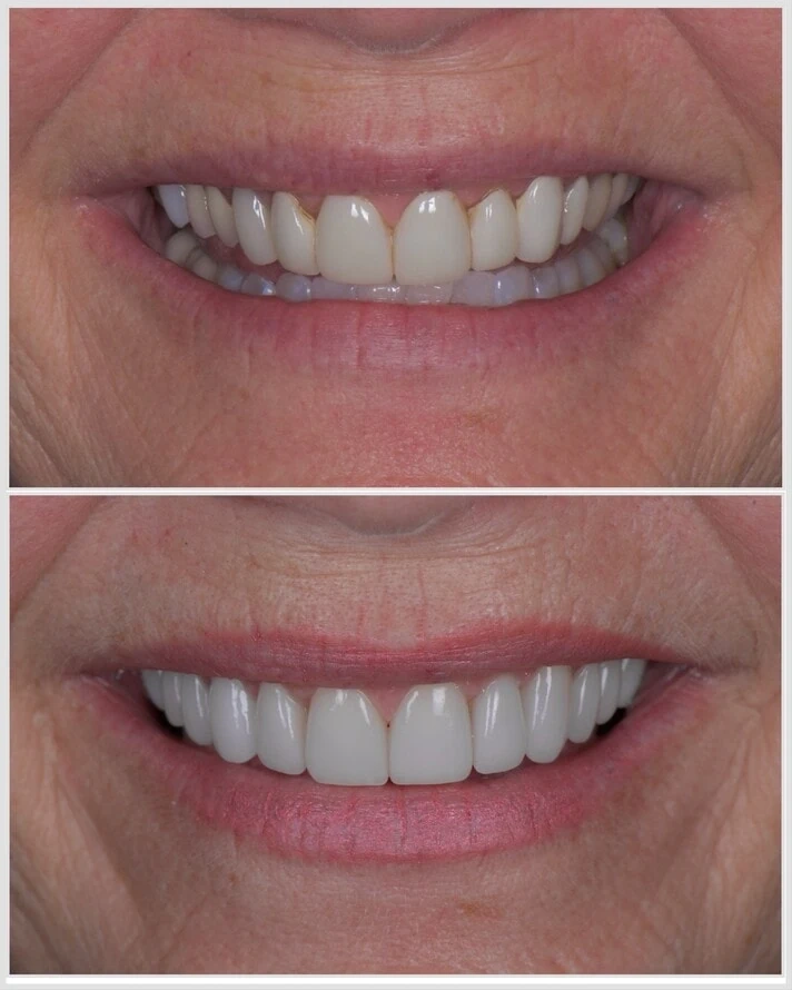 Veneers
