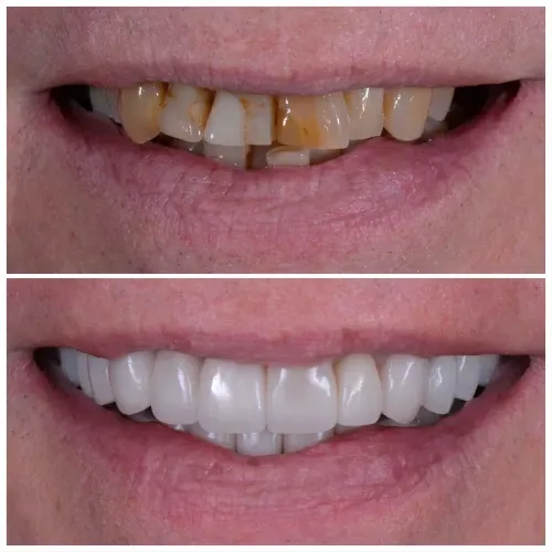 Veneers