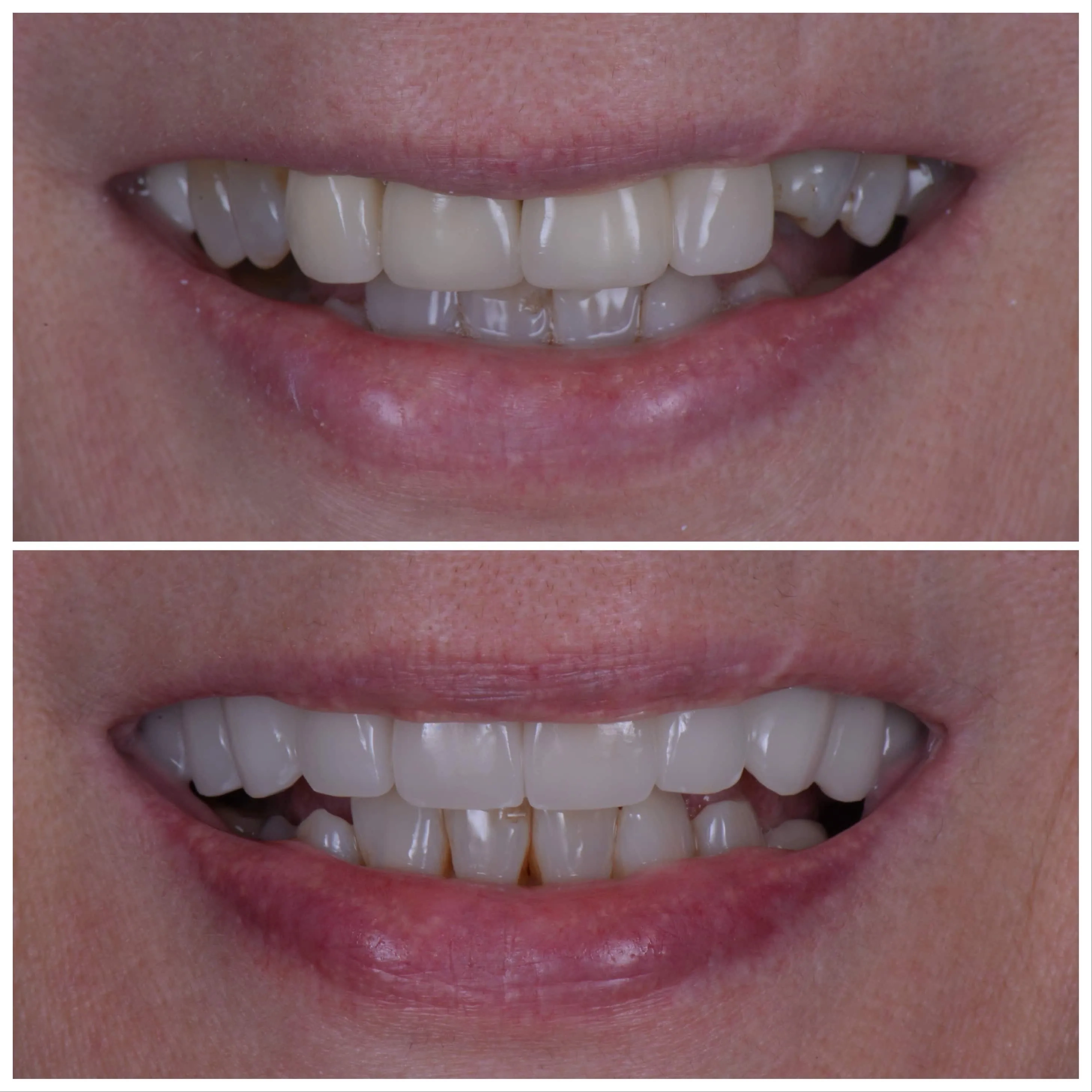 Veneers